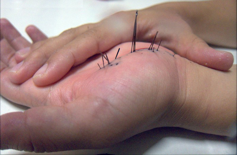 صدمات ناشی از حیوانات دریایی تیغ توتیا